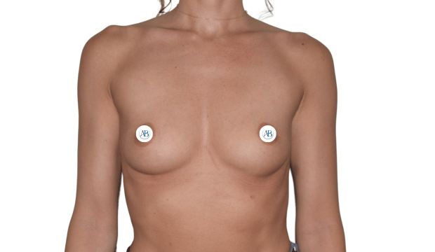 aumento pecho bilbao